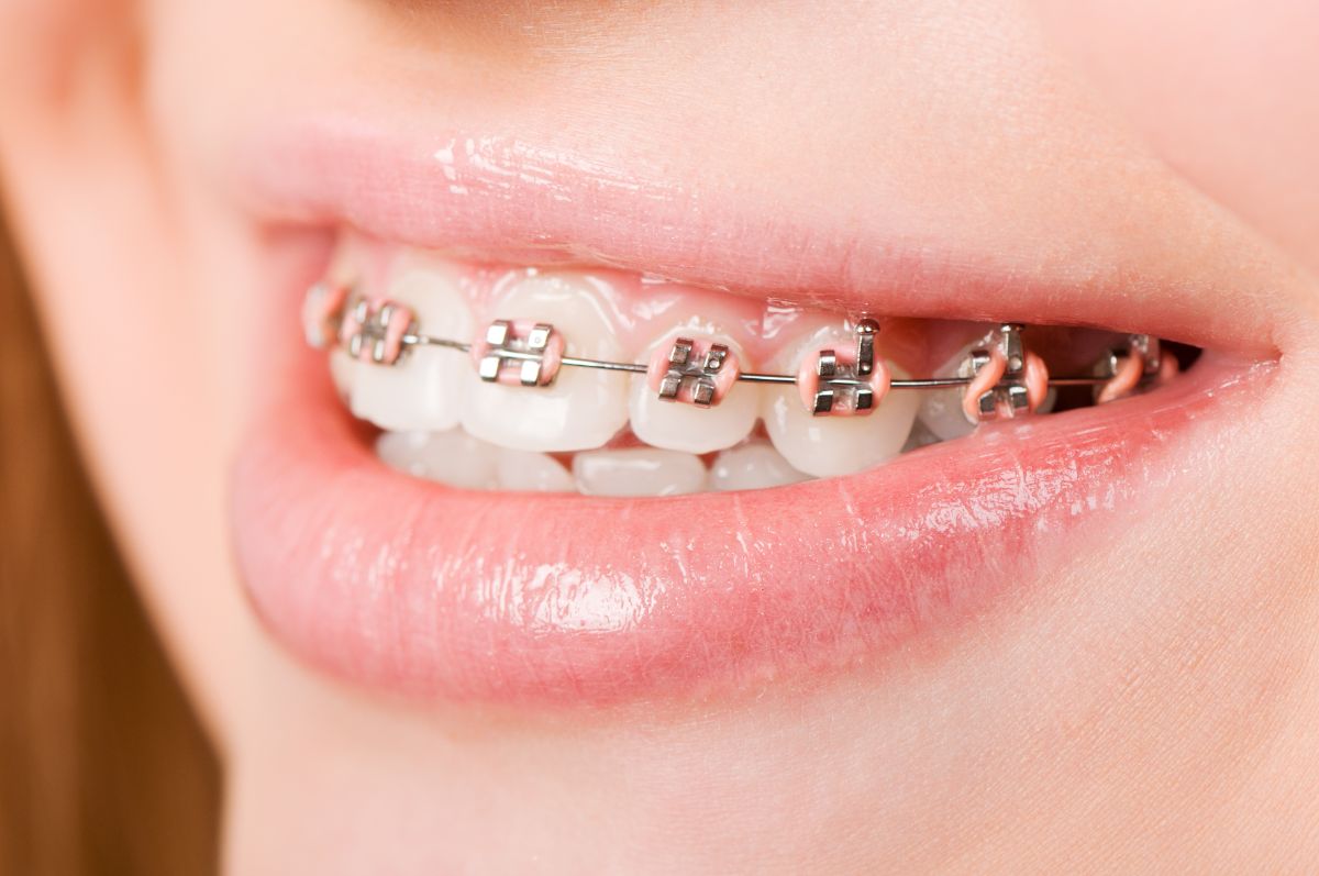 7 Tips for Brushing Your Teeth with Braces